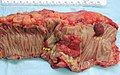 Gross appearance of a colectomy specimen containing two adenomatous polyps (the brownish oval tumors above the labels, attached to the normal beige lining by a stalk) and one invasive colorectal carcinoma (the crater-like, reddish, irregularly shaped tumor located above the label)