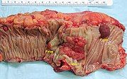 Gross appearance of a colectomy specimen containing two adenomatous polyps (the brownish oval tumors above the labels, attached to the normal beige lining by a stalk) and one invasive colorectal carcinoma (the crater-like, reddish, irregularly shaped tumor located above the label).