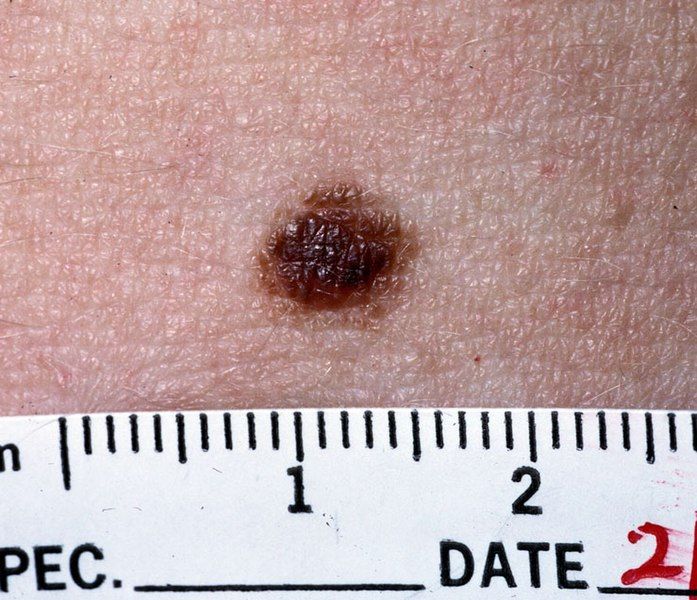 File:Nevus NCI.jpg