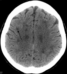 A black and white CT image of a cross-section of the skull and brain