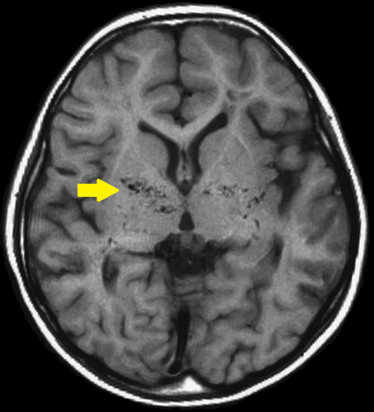 File:Moyamoya disease-MRI T1.png