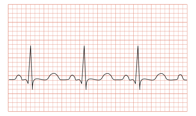 File:Tachycardia ECG paper.svg