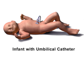 Infant with umbilical catheter