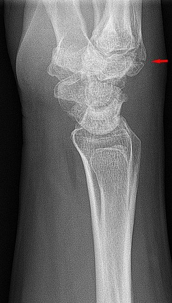 File:Carpal-boss-xray.jpg