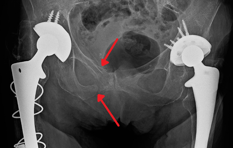 File:FractureRtSandIRami(Sin2).png