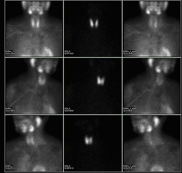 File:Parathyroid subtraction.jpg