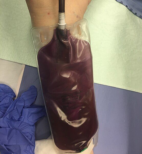 File:PurpleUrine.jpg