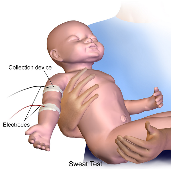 File:Sweat Test Infant.png