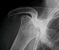 Radiography of total avascular necrosis of right humeral head. Woman of 81 years with diabetes of long evolution.