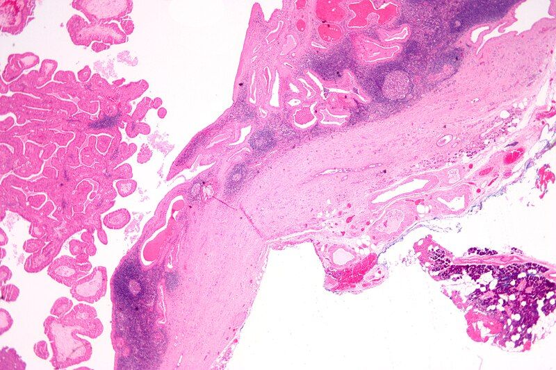 File:Papillary cystadenoma lymphomatosum1.jpg