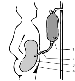 File:Peritoneal dialysis intl.svg