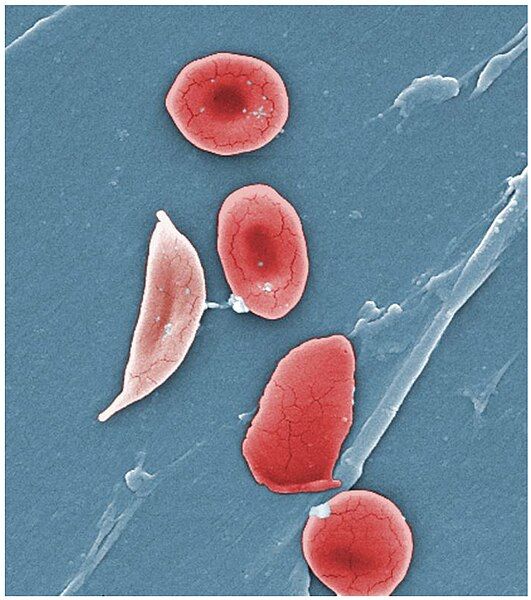 File:1911 Sickle Cells.jpg