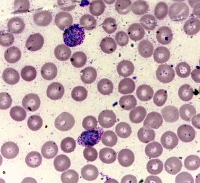 File:Plasmodium vivax malaria.jpg