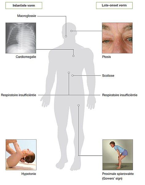 File:Pompe symptomen.jpg