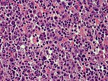 Cutaneous diffuse large B-cell lymphoma (DLBCL)