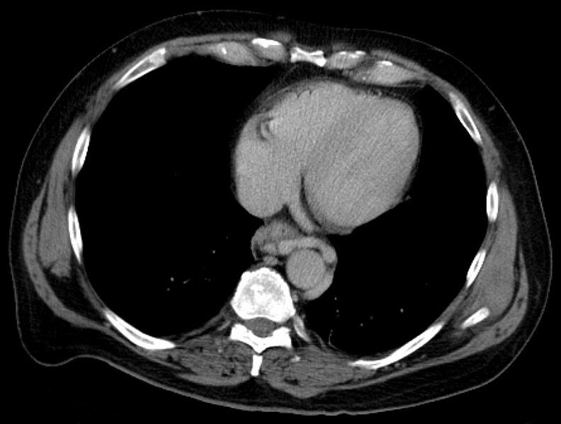 File:Oesophagusvarizen 02.jpg