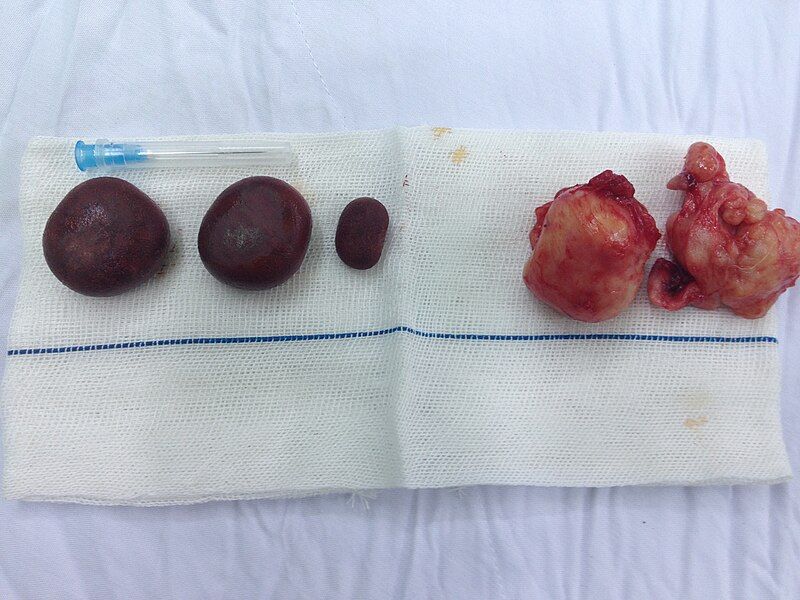 File:Bladder stones.jpg