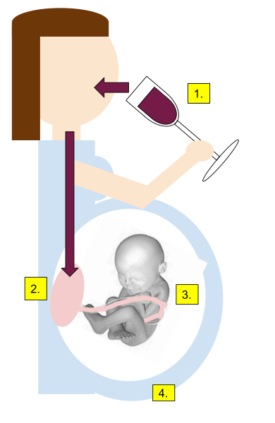 File:Fetal Alcohol Syndrome.svg