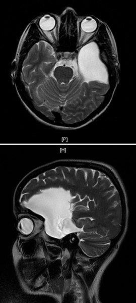 File:Arachnoid cyst (cropped).jpg