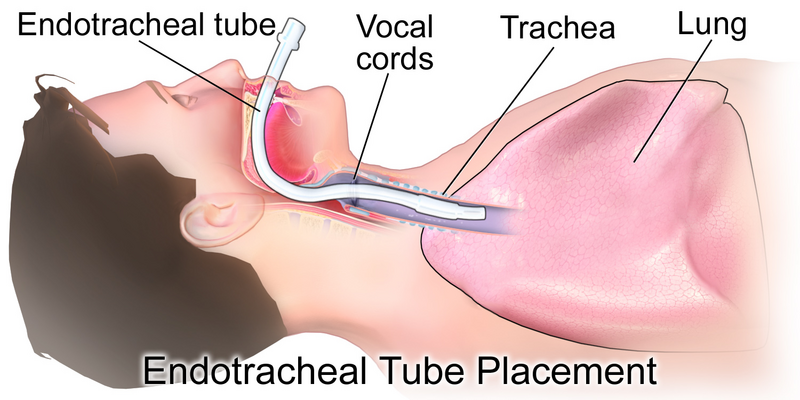 File:Endotracheal Tube.png