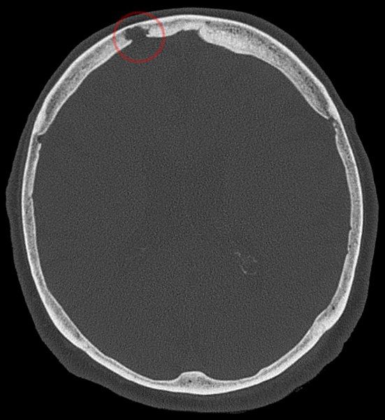 File:Pacchioni-Granulation CT KF.jpg