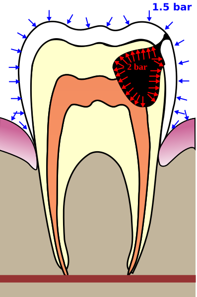 File:Barodontalgia.svg