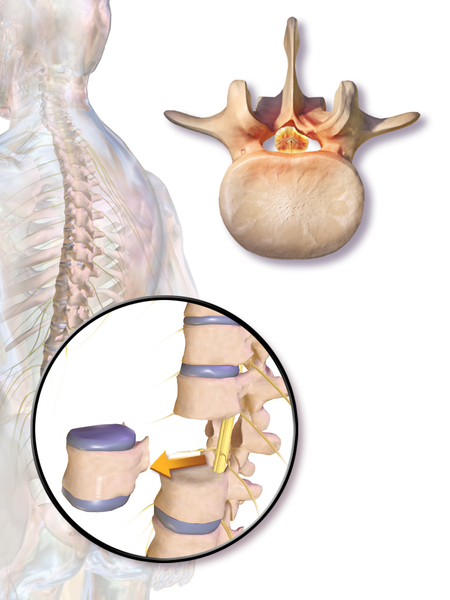 File:Corpectomy.png