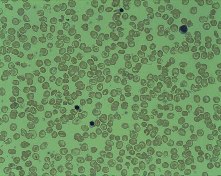 File:Delta Beta Thalassemia.jpg