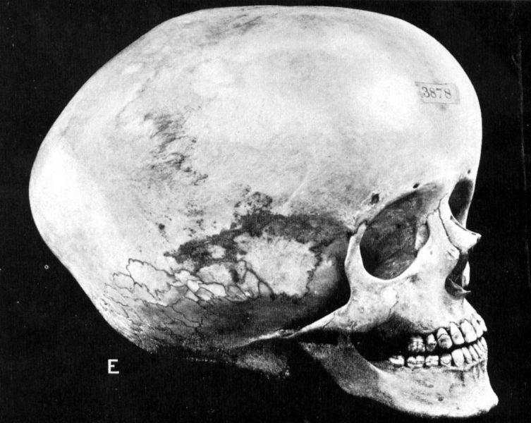 File:Hydrocephalic skull.jpg