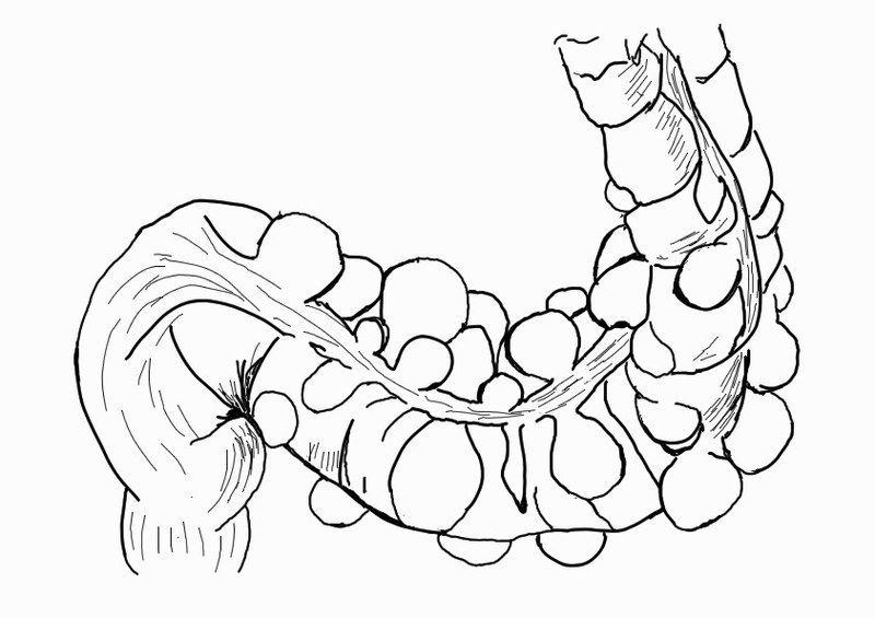 File:Sigmoid diverticulum (diagram).jpg