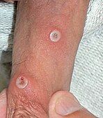 Mpox lesions on a penis