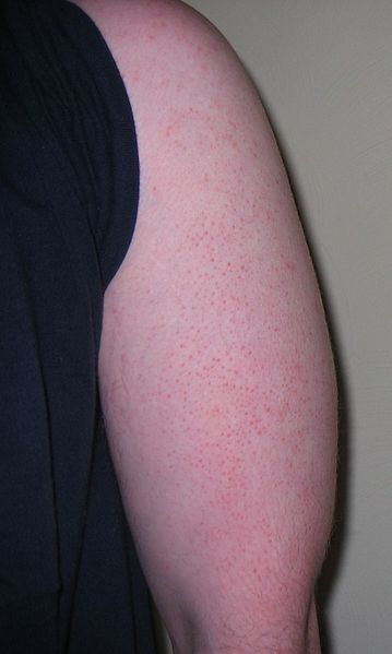 File:KeratosisPilaris.jpg