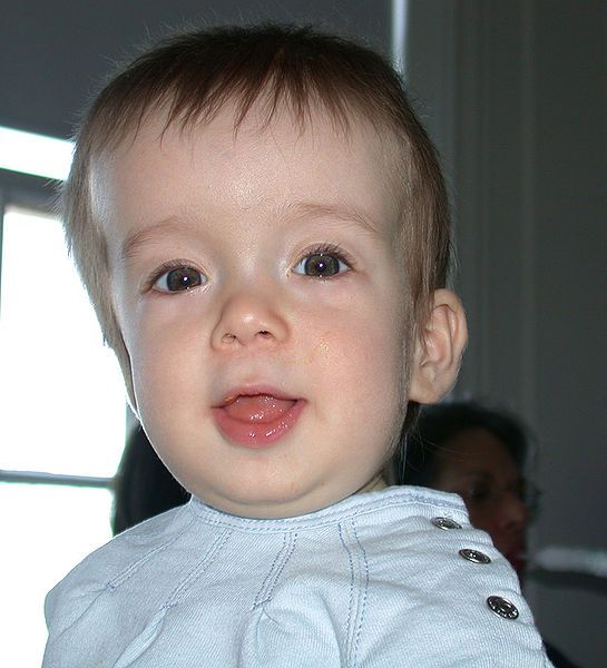 File:Cranialsynostosis.jpg