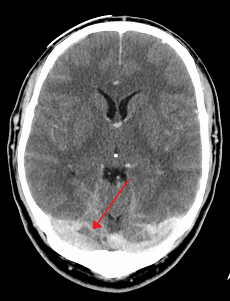 File:Duralvenoussinusthrombosis.png