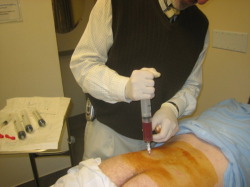 File:Bone marrow aspiration.jpg