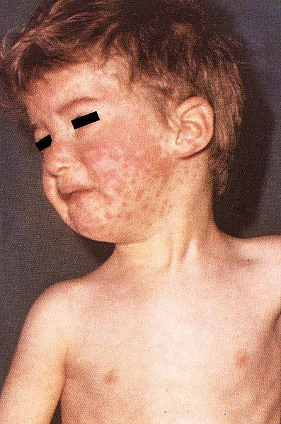 File:Boy with measles.jpg