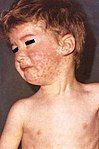 Boy with measles