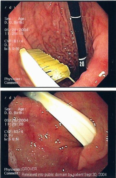 File:Foreign Body.jpg