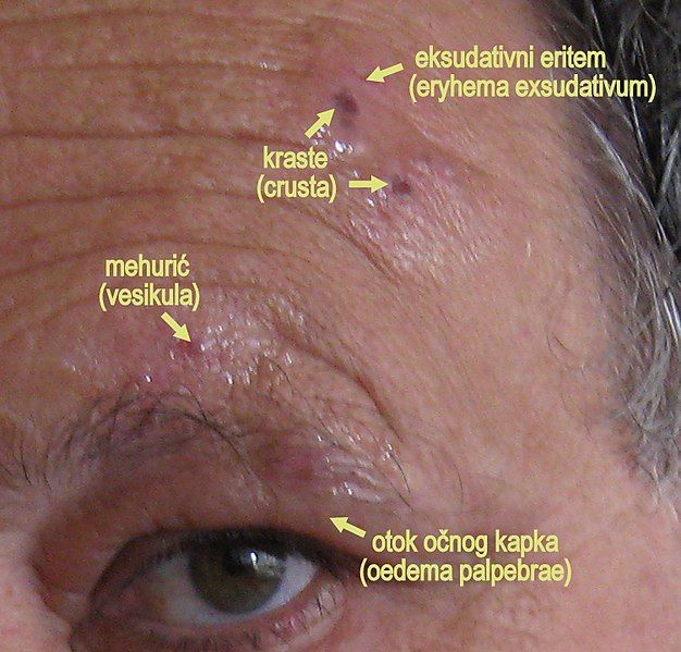 File:Herpes zoster ophthalmicus.2.jpg