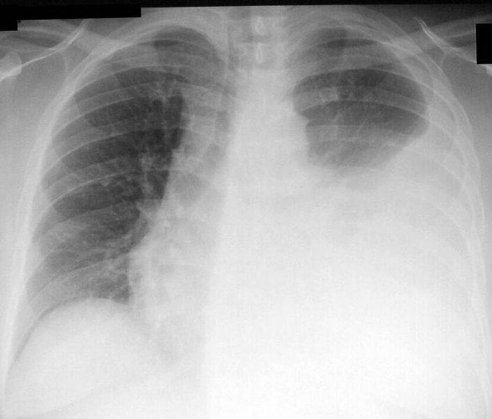 File:Left-sided Pleural Effusion.jpg