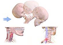 An animated image showing the mechanisms of whiplash