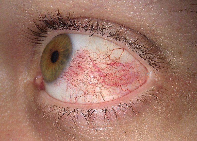 File:Hyperemia conjunctiva.jpg