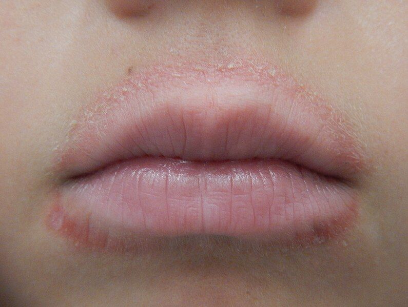 File:Lip licker's dermatitis.jpg