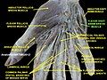 Flexor digiti minimi brevis muscle