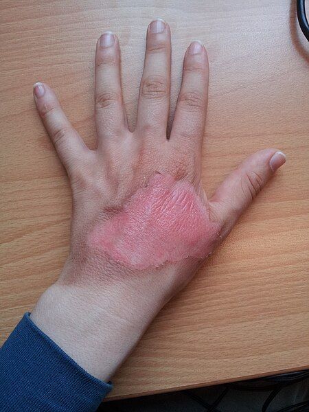 File:1Veertje hand-burn-d08.jpg