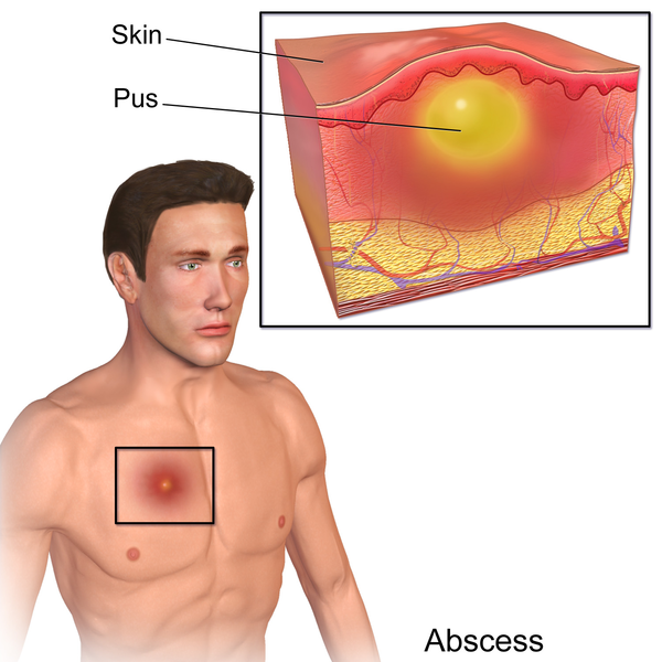 File:Blausen 0007 Abscess.png