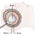 Decompressive Craniectomy