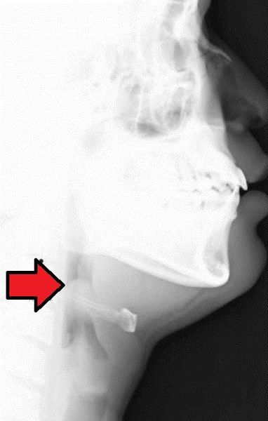 File:Epiglottitis.jpg