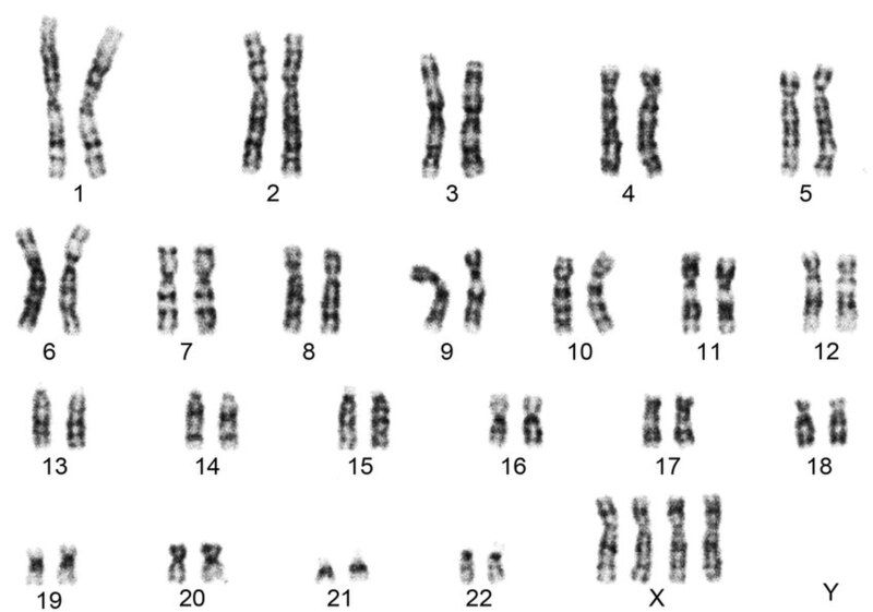 File:G-banded-chromosomal-analysis-showing-48-XXXX.jpg