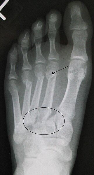 File:Lisfranc fracture.jpg